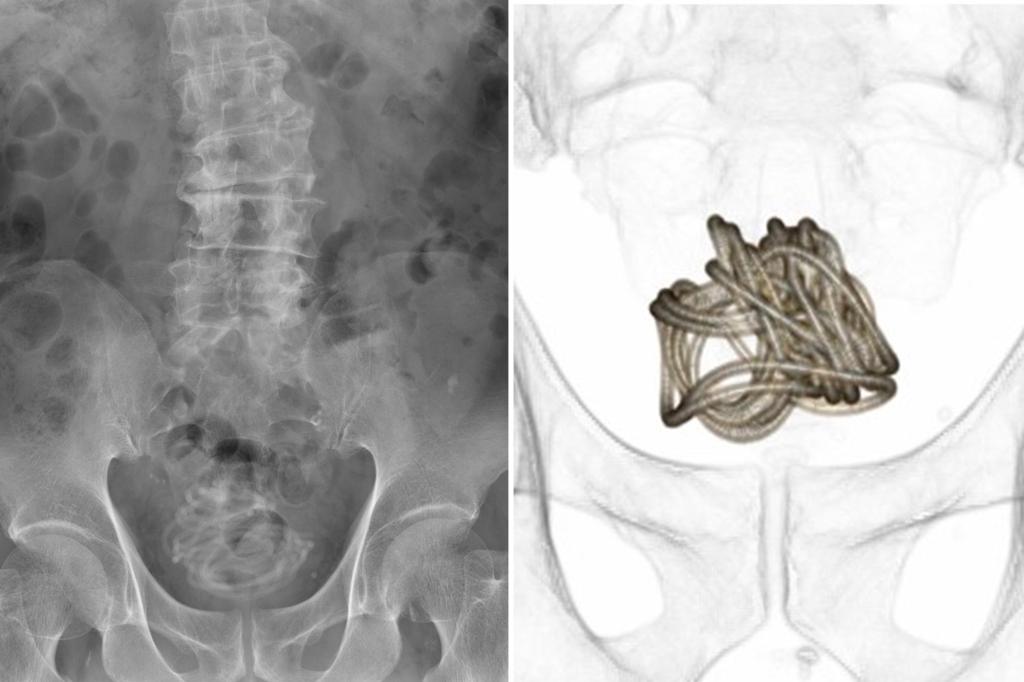 Man gets jump rope stuck in bladder after shoving it into  penis