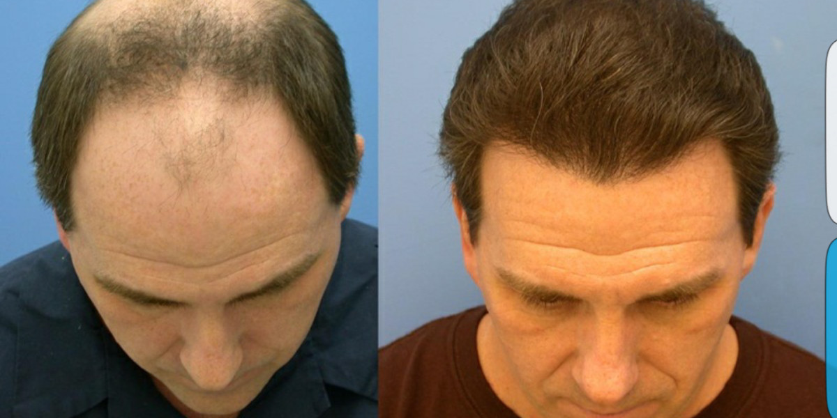 Hair Restoration California