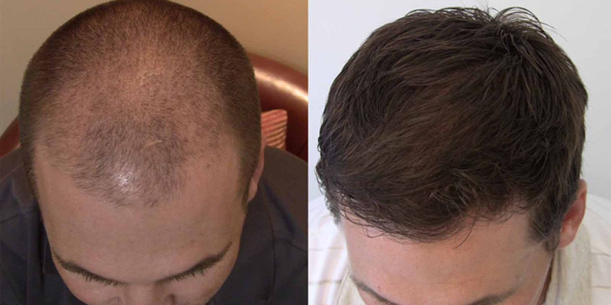 Reclaim Your Confidence: The Ultimate Guide To Hair Transplant