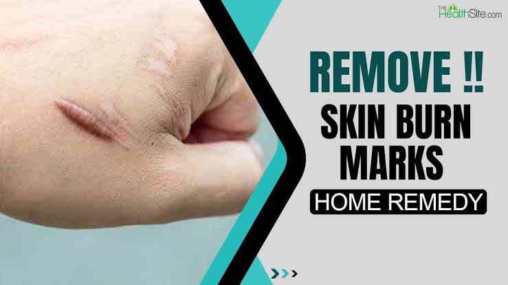Remove burn marks - Care Beauty