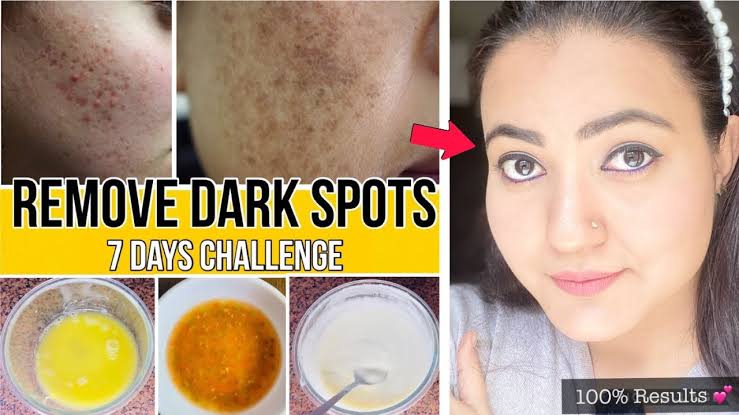 Natural ways to remove skin pigmentation and dark spots - Care Beauty