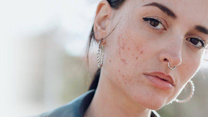 5 Misinformation About the Relationship Between Acne and Food, From Ear to Ear - Care Beauty