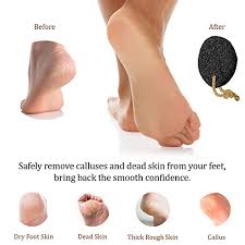 9 Things to Easily Get Rid of Foot Calluses - Care Beauty