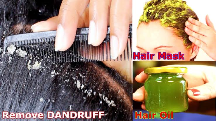 The easiest way to get rid of dandruff   - Care Beauty