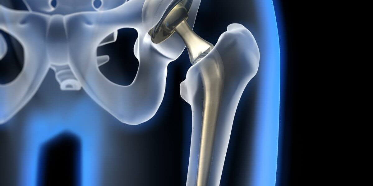 Hip Implants Market Analysis, Opportunities, Latest Innovations, Top Players Forecast 2030