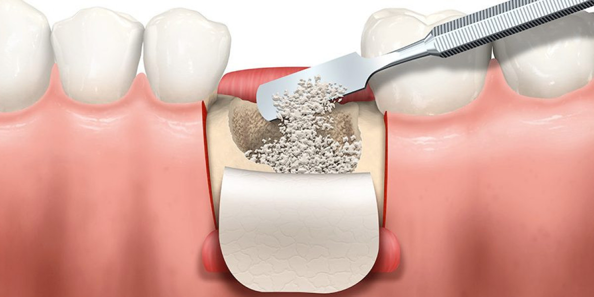 Dental Bone Graft Substitute Market Growth, Opportunities and Development 2030