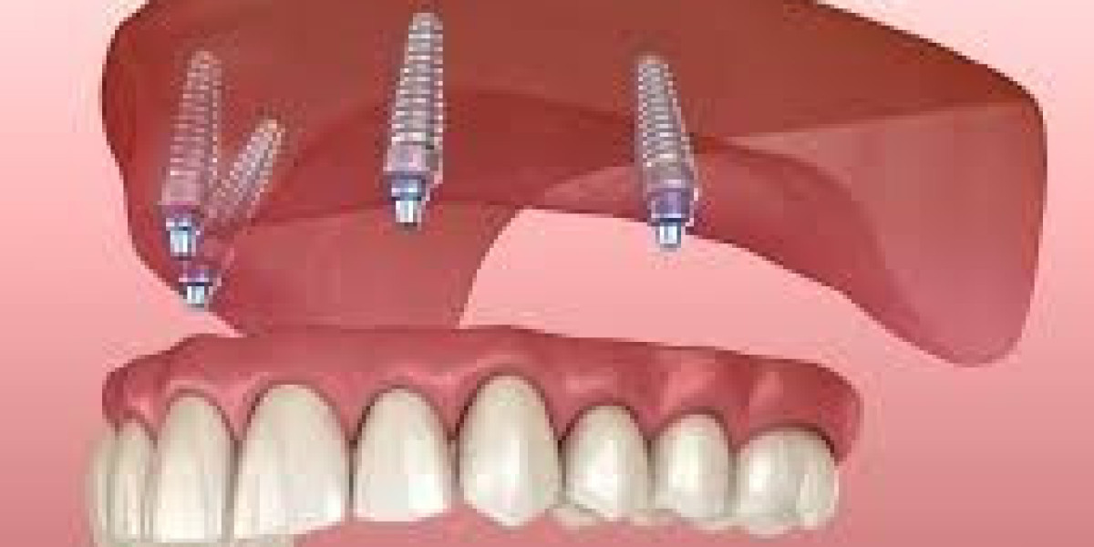 Global Fixed Denture Market to Reach USD 5.3 Billion by 2032 | CAGR 4.21% | USD 3.81 Billion Valued in 2024