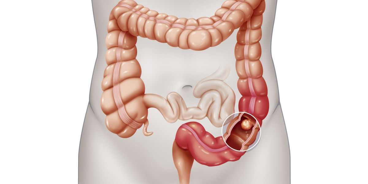 Colorectal Cancer Treatment Market <br>Overview, Scope, Trends and Industry Research Report 2030