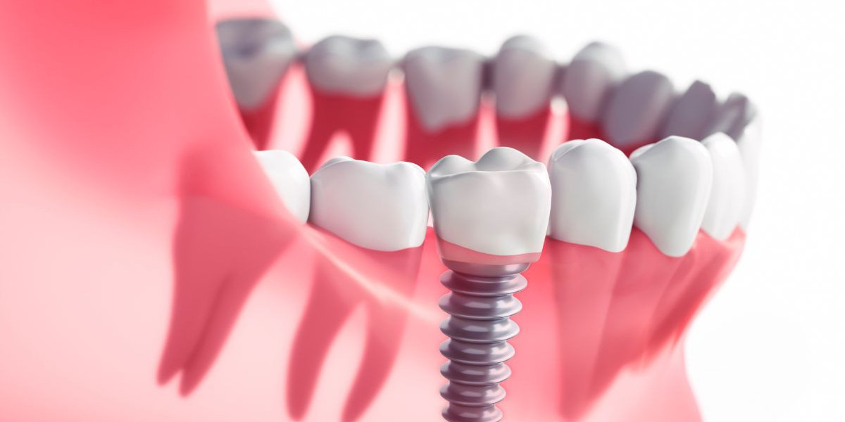 Explora el Mercado de Implantes Dentales: Tendencias y Oportunidades